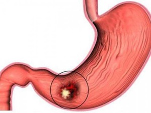 Принцип лечения язвенной болезни желудка и 12-перстной кишки