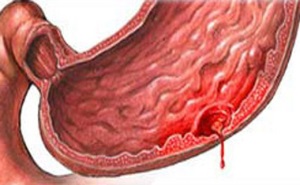 Осложнение язвенной болезни — кровотечение