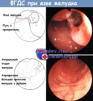 Язвенная болезнь желудка (язва желудка) и двенадцатиперстной кишки