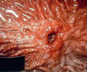 При язвенной болезни часто развивается анемия