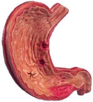 Первые симптомы язвы желудка у взрослых на ранней стадии