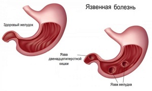Лечебное питание при язвенной болезни желудка и двенадцатиперстной кишки
