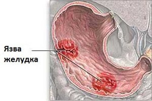 Лекарства от гастрита и язвы желудка