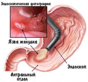 Диета при язве желудка