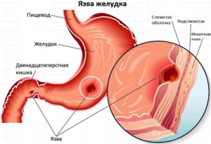 Сборы трав при язвенной болезни желудка