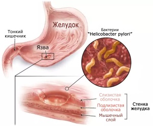 ГАСТРИТ