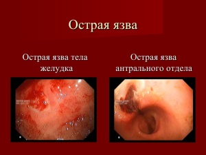 Способы применения и польза облепихового масла при язве желудка