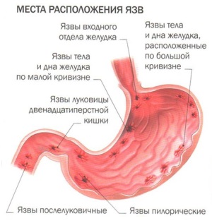 Фрукты при язве желудка: яблоки, груши, бананы, гранат, хурма, лимон и другие