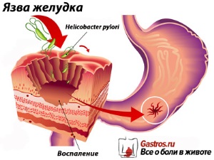 Пенетрирующая язва — хирургическое осложнение язвенной болезни