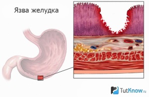 Какие овощи можно при язве желудка?