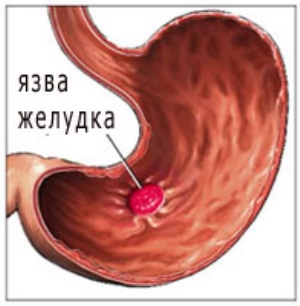 Как я вылечила ЯЗВУ ЖЕЛУДКА и 12-ПЕРСТНОЙ КИШКИ за 1 неделю