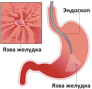 Медикаментозное лечение пептической язвы