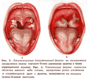 Диета при язвенной болезни желудка и 12-перстной кишки
