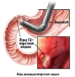 Панкреатит. Гастрит. Язва желудка. Двенадцатиперстная кишка. Хеликобактер пилори. Лечение Актовегином