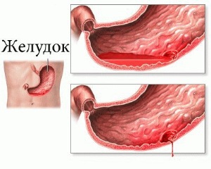 Шиповник при язве желудка и двенадцатиперстной кишки