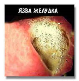 Какой диеты придерживаться после операции на язву желудка?