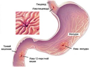 Куриные пупки от гастрита