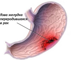 Травы и чаи при язве желудка и двенадцатиперстной кишки: что пить для лечения