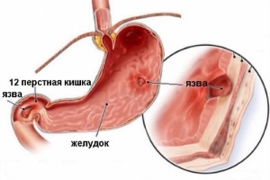 1-, 2-, 3- и 4-компонентные схемы лечения язвенной болезни