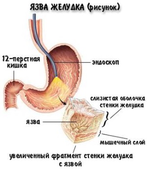 Бананы при гастрите