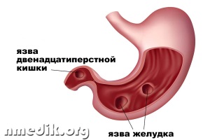 Цвет кала при язве желудка