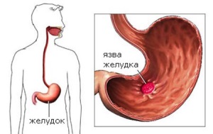 Диагностика перфоративной язвы желудка и двенадцатиперстной кишки