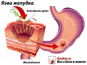 МКБ 10 язвенной болезни желудка