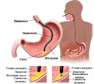 Язвенная болезнь желудка и 12-перстной кишки