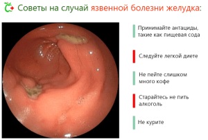 Квашеная капуста при язве желудка